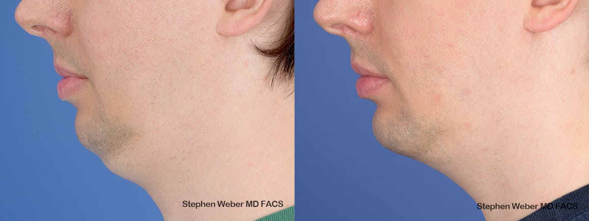 Chin Implant Before & After Gallery - Patient 290274 - Image 2