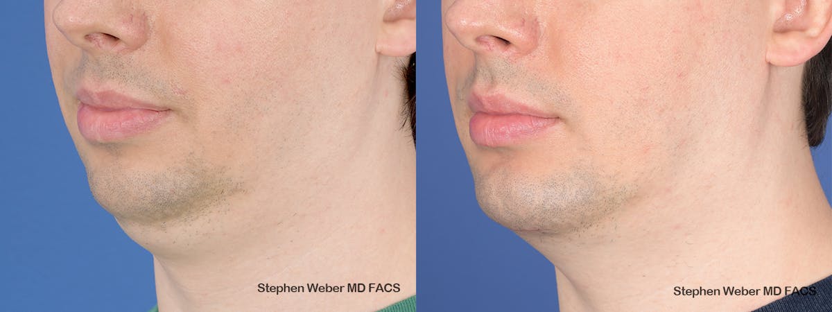 Chin Implant Before & After Gallery - Patient 290274 - Image 3