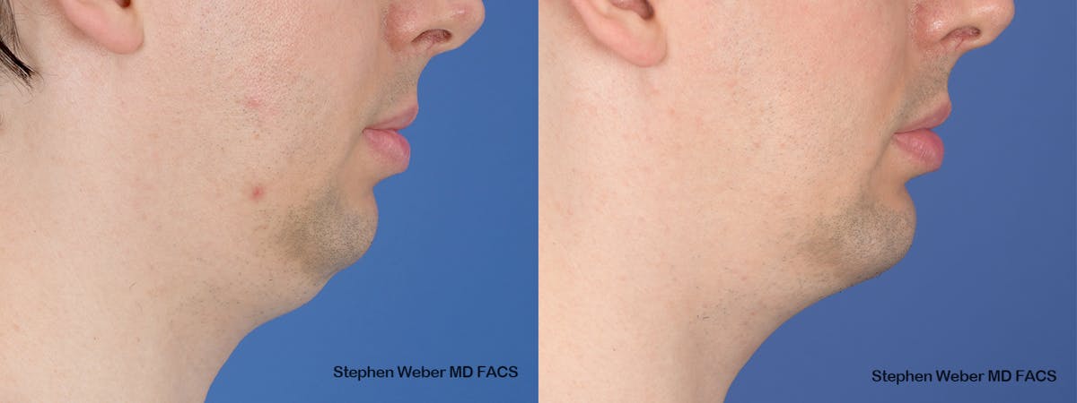 Chin Implant Before & After Gallery - Patient 290274 - Image 4