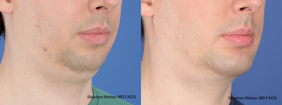 Chin Implant Before & After Gallery - Patient 290274 - Image 5