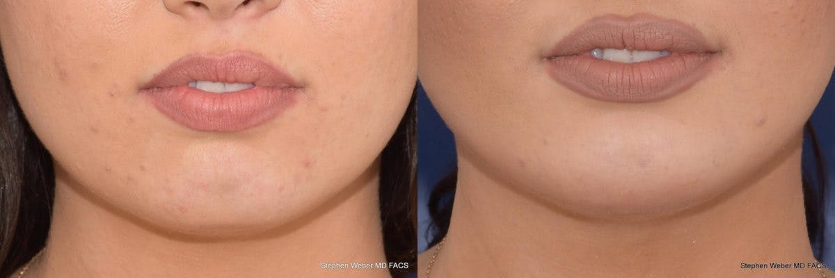 Chin Implant Before & After Gallery - Patient 355241 - Image 1