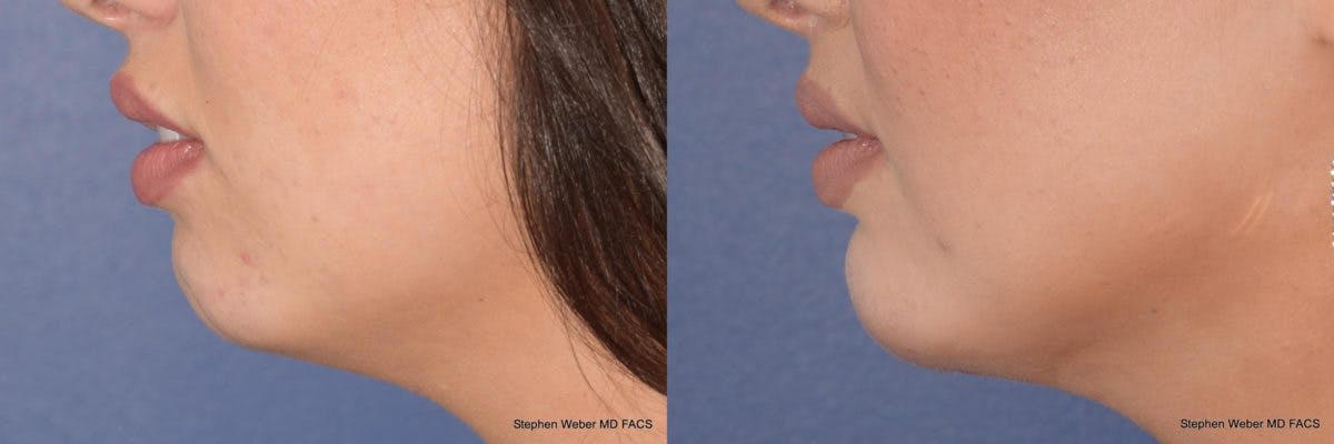 Chin Implant Before & After Gallery - Patient 355241 - Image 2
