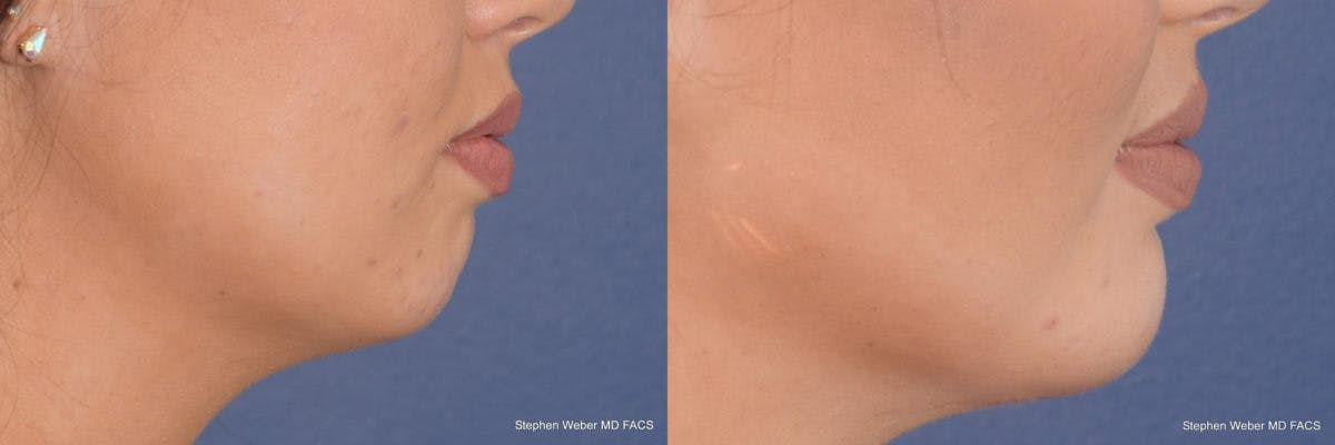 Chin Implant Before & After Gallery - Patient 355241 - Image 3
