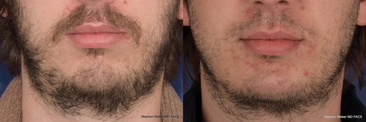 Chin Implant Before & After Gallery - Patient 355298 - Image 1