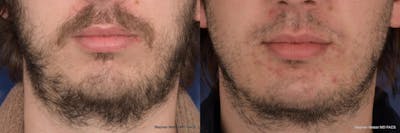 Chin Implant Before & After Gallery - Patient 355298 - Image 1