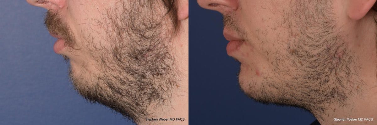Chin Implant Before & After Gallery - Patient 355298 - Image 2