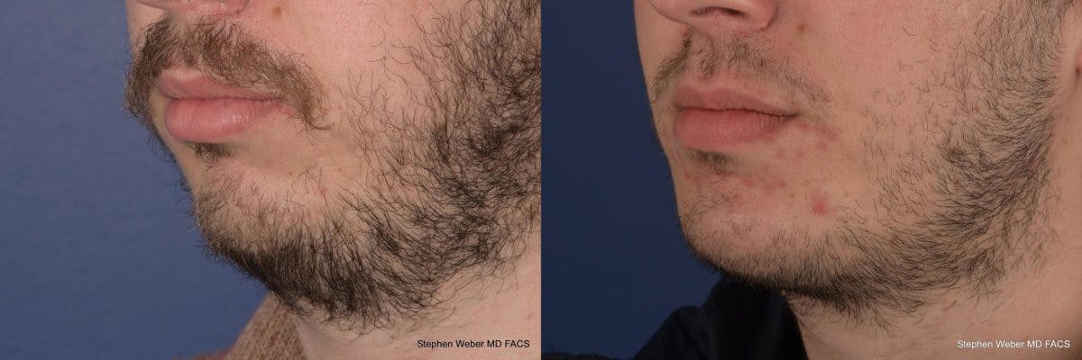 Chin Implant Before & After Gallery - Patient 355298 - Image 3