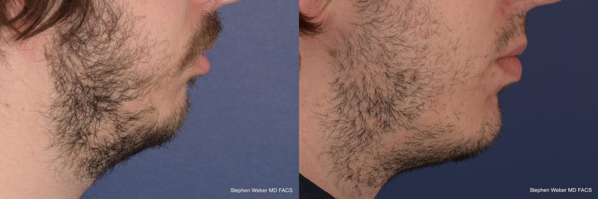 Chin Implant Before & After Gallery - Patient 355298 - Image 4