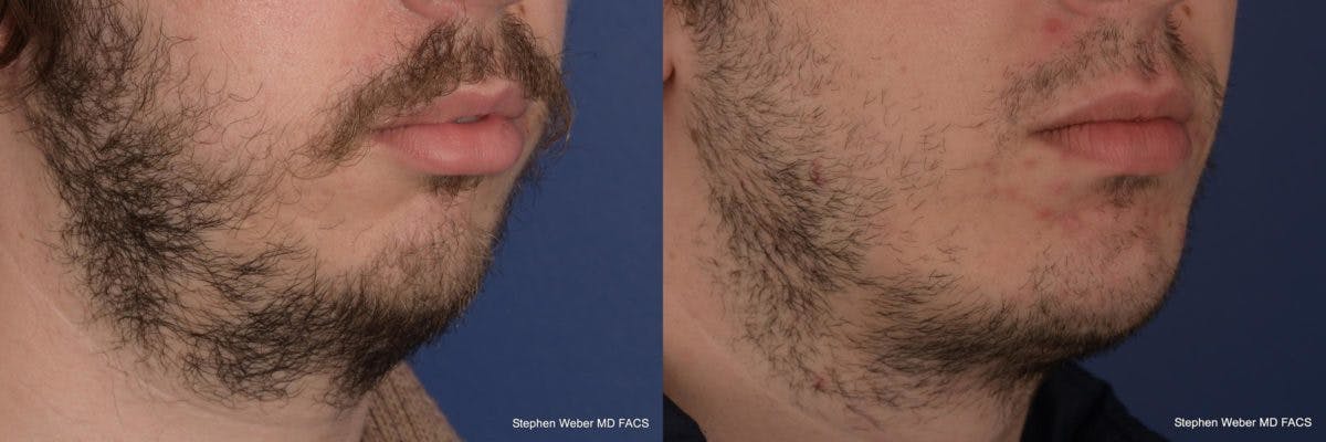 Chin Implant Before & After Gallery - Patient 355298 - Image 5