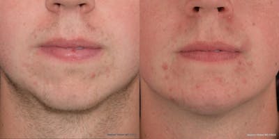 Chin Implant Before & After Gallery - Patient 348590 - Image 1