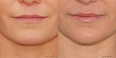 Chin Implant Before & After Gallery - Patient 255759 - Image 1