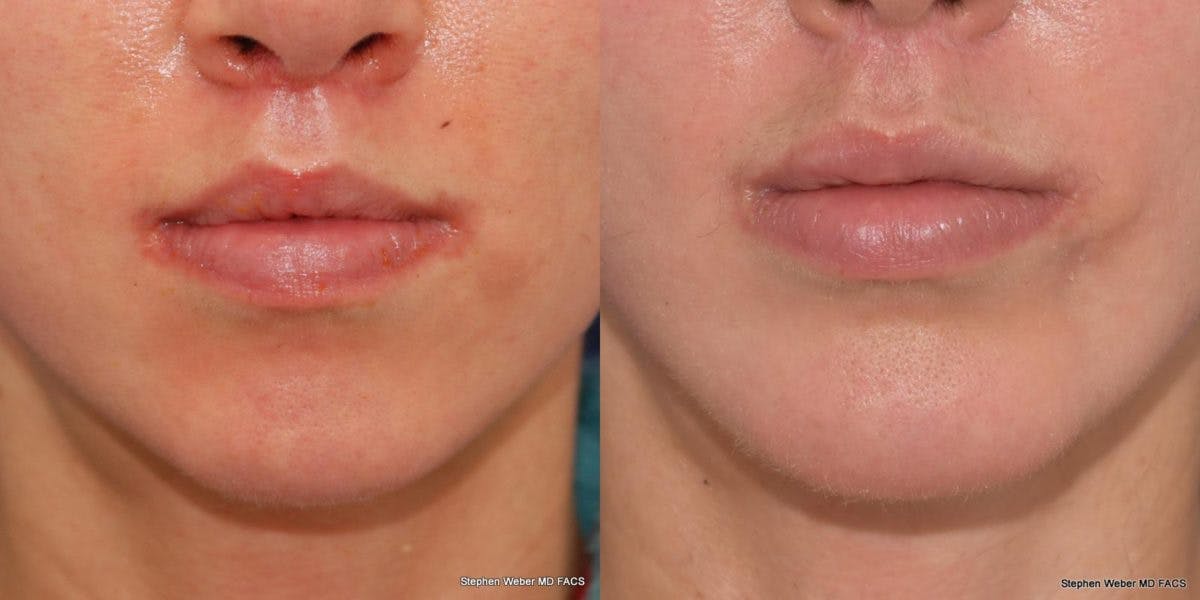 Chin Implant Before & After Gallery - Patient 191898 - Image 1