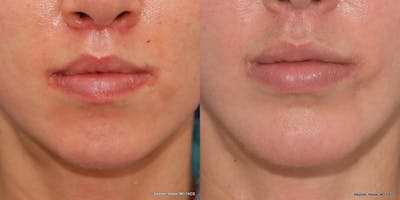 Chin Implant Before & After Gallery - Patient 191898 - Image 1