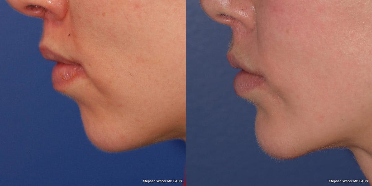 Chin Implant Before & After Gallery - Patient 191898 - Image 2