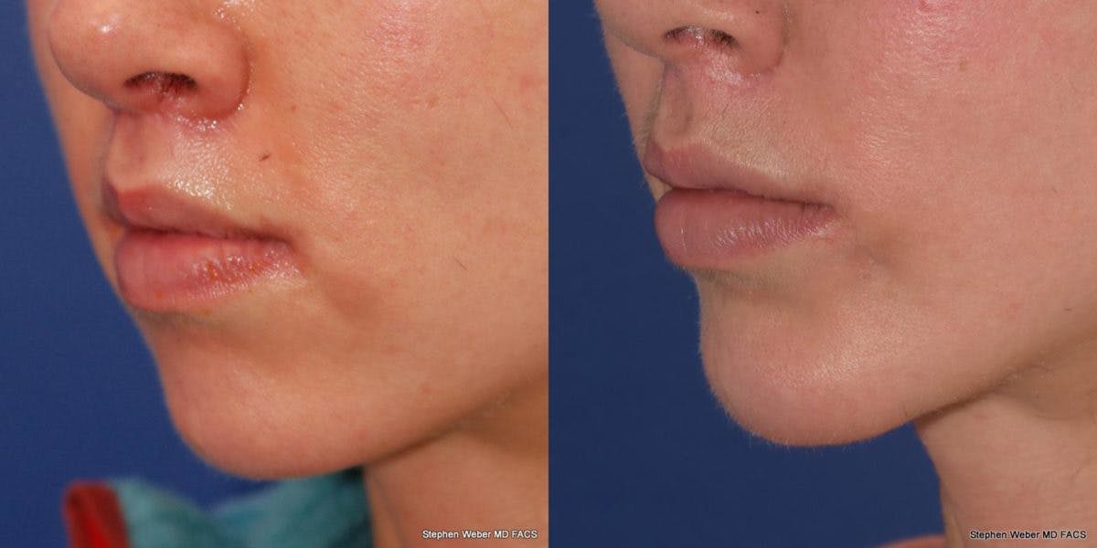 Chin Implant Before & After Gallery - Patient 191898 - Image 3
