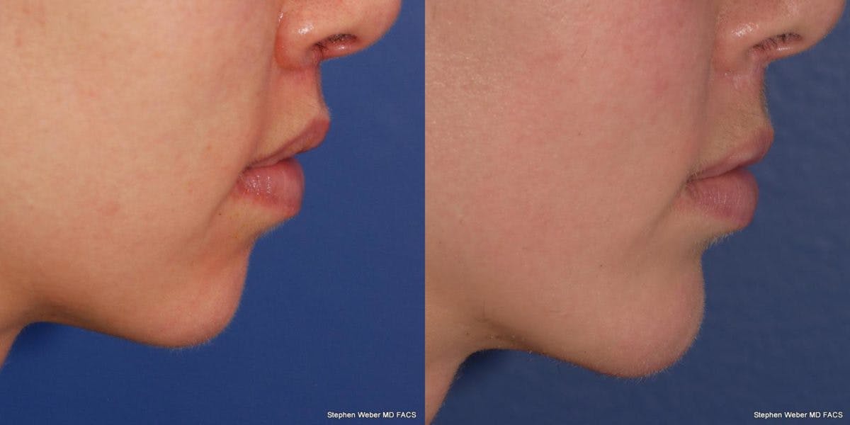 Chin Implant Before & After Gallery - Patient 191898 - Image 4