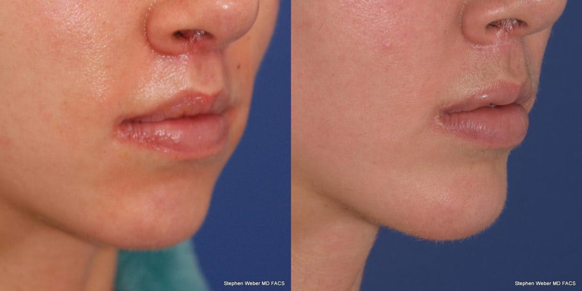 Chin Implant Before & After Gallery - Patient 191898 - Image 5