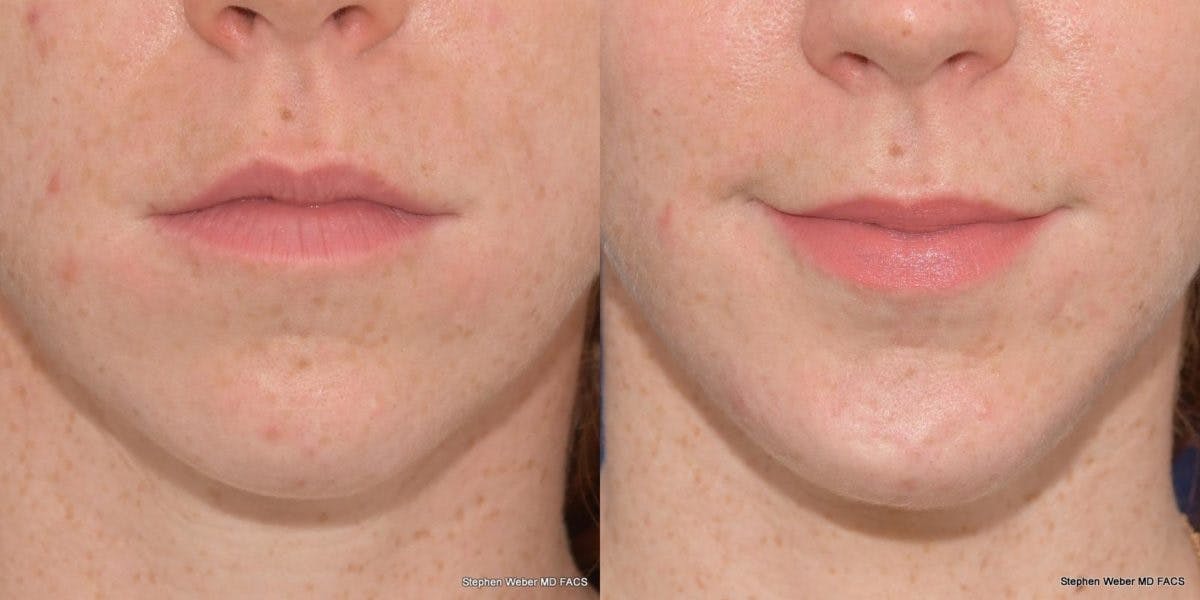 Chin Implant Before & After Gallery - Patient 818608 - Image 1