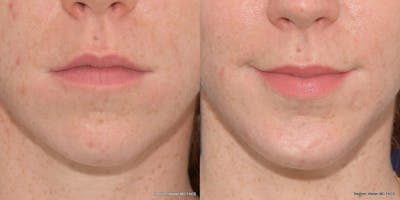 Chin Implant Before & After Gallery - Patient 818608 - Image 1