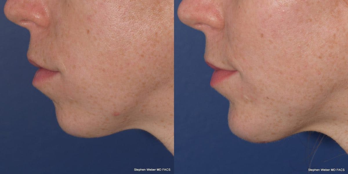 Chin Implant Before & After Gallery - Patient 818608 - Image 2
