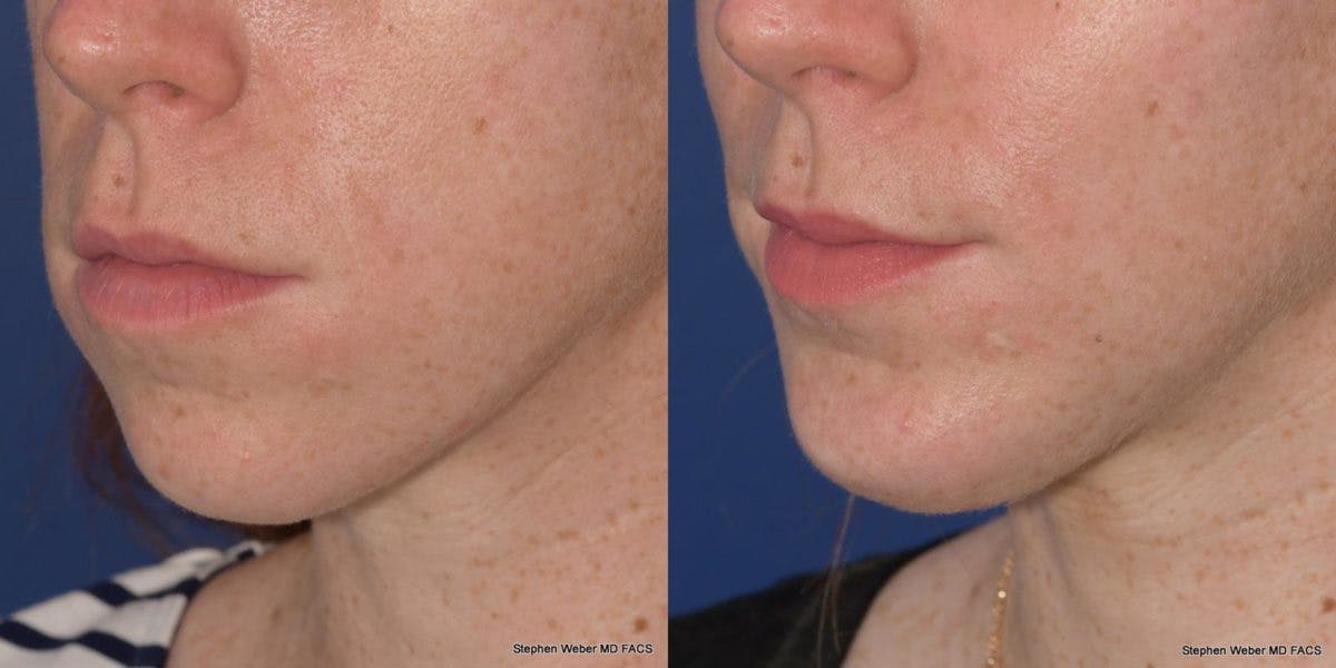 Chin Implant Before & After Gallery - Patient 818608 - Image 3