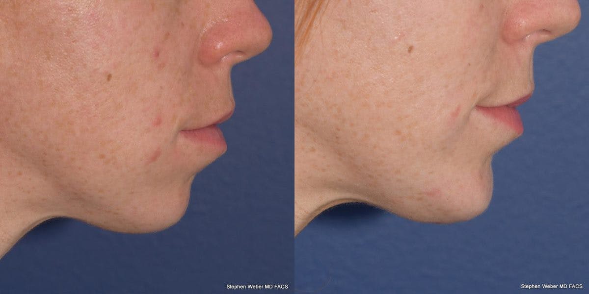Chin Implant Before & After Gallery - Patient 818608 - Image 4