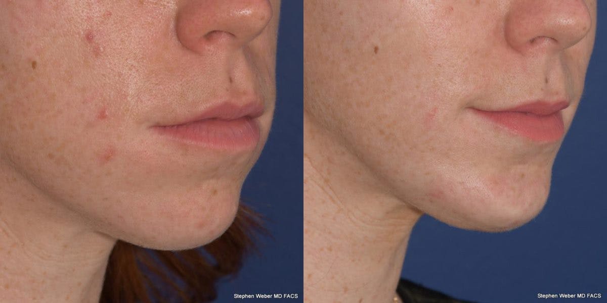 Chin Implant Before & After Gallery - Patient 818608 - Image 5