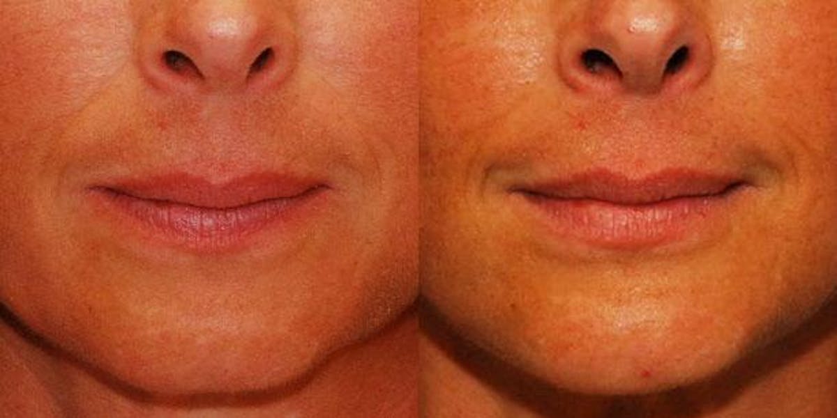 Chin Implant Before & After Gallery - Patient 331319 - Image 1