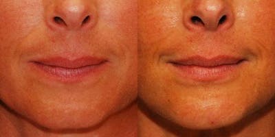 Chin Implant Before & After Gallery - Patient 331319 - Image 1