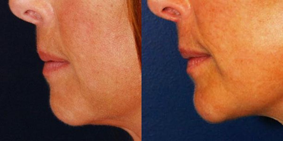 Chin Implant Before & After Gallery - Patient 331319 - Image 2