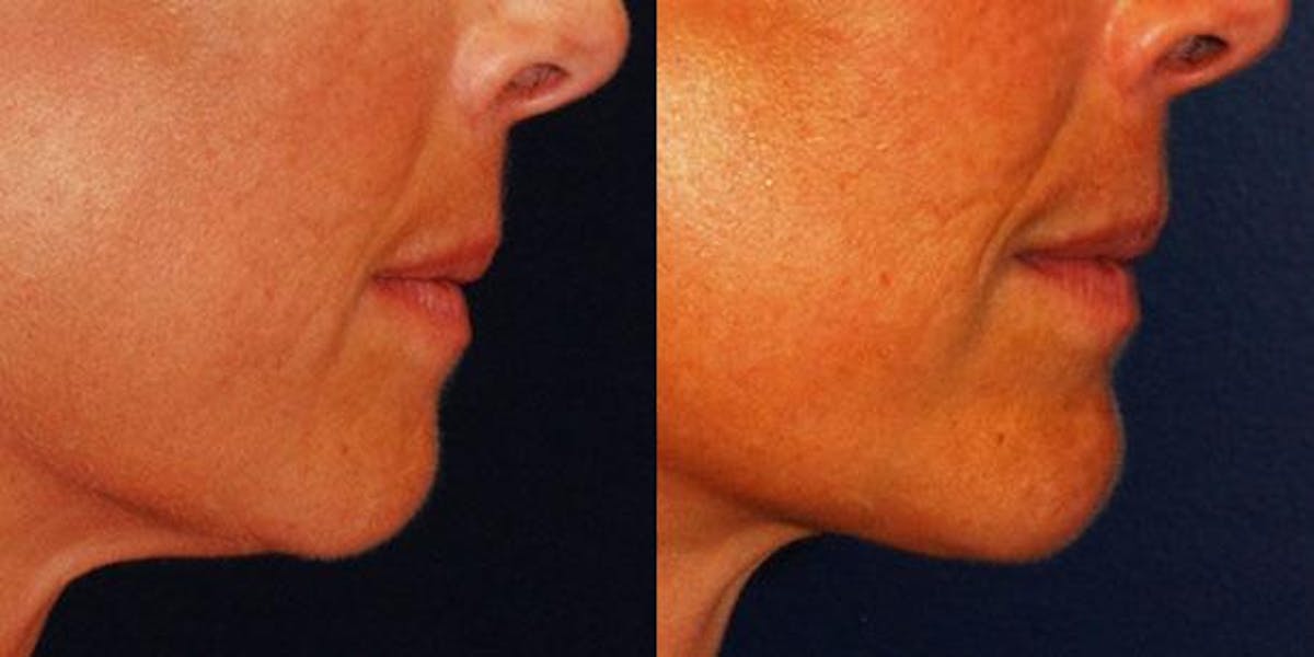 Chin Implant Before & After Gallery - Patient 331319 - Image 3