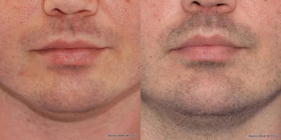 Chin Implant Before & After Gallery - Patient 301828 - Image 1