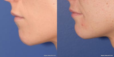 Chin Implant Before & After Gallery - Patient 301995 - Image 1