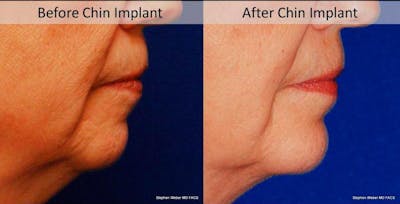 Chin Implant Before & After Gallery - Patient 408308 - Image 1
