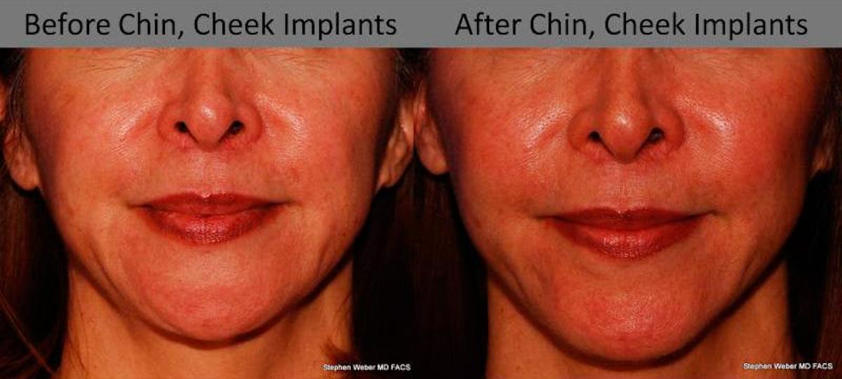 Chin Implant Before & After Gallery - Patient 284928 - Image 1