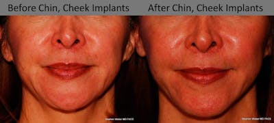 Chin Implant Before & After Gallery - Patient 284928 - Image 1