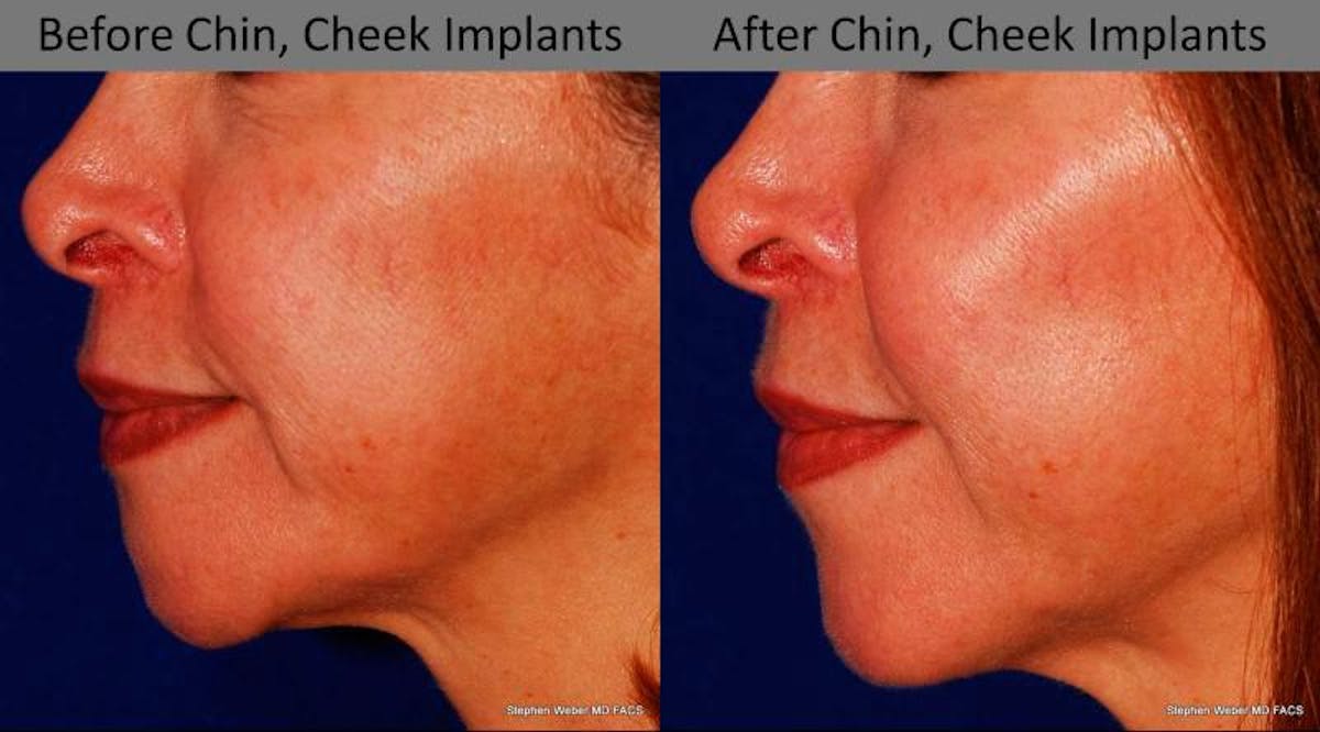 Chin Implant Before & After Gallery - Patient 284928 - Image 2