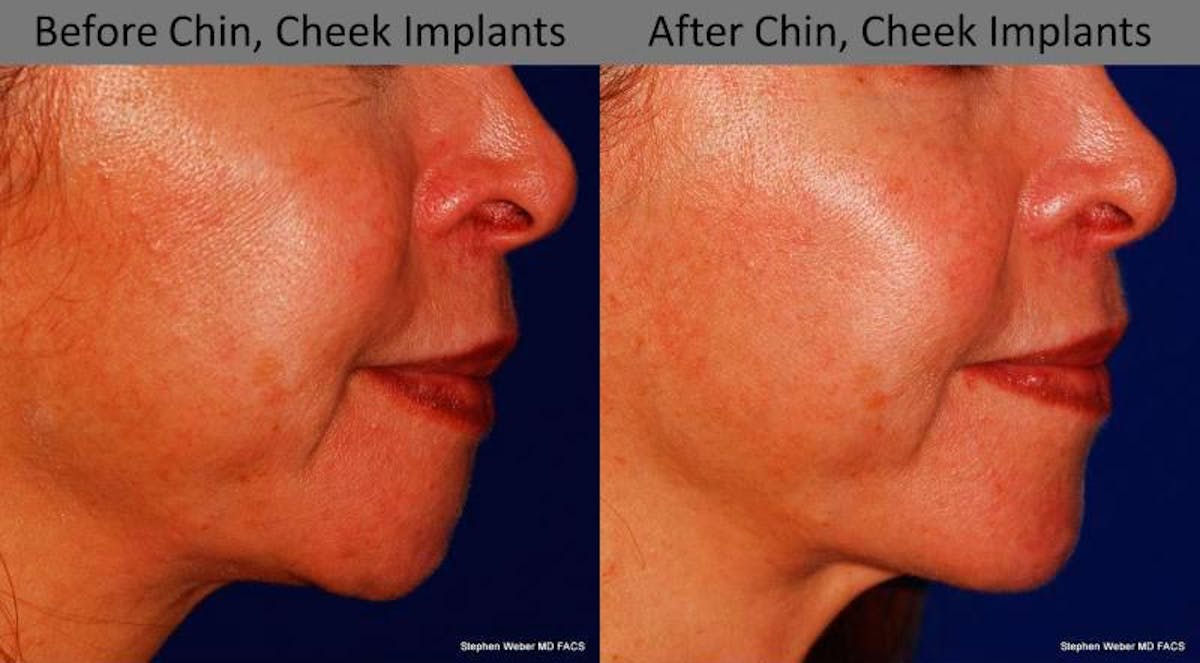 Chin Implant Before & After Gallery - Patient 284928 - Image 3