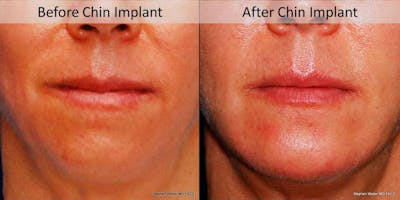 Chin Implant Before & After Gallery - Patient 250430 - Image 1