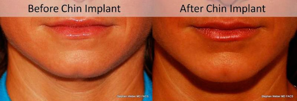 Chin Implant Before & After Gallery - Patient 179445 - Image 1