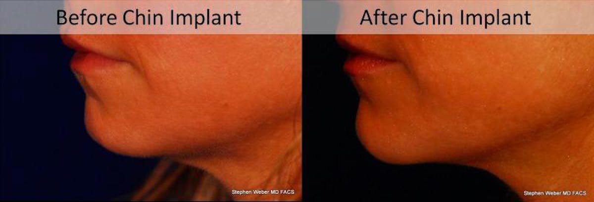 Chin Implant Before & After Gallery - Patient 179445 - Image 2