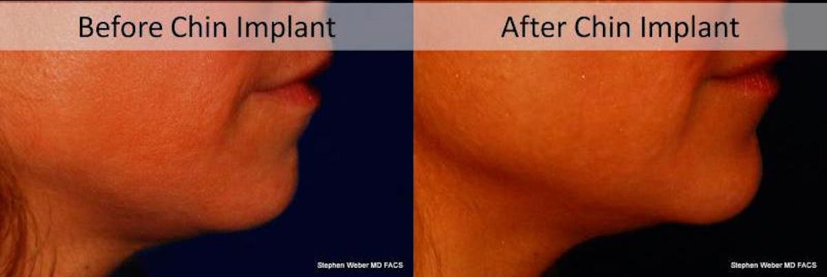 Chin Implant Before & After Gallery - Patient 179445 - Image 3