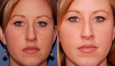 Rhinoplasty Before & After Gallery - Patient 390273 - Image 1
