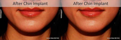 Chin Implant Before & After Gallery - Patient 329552 - Image 1