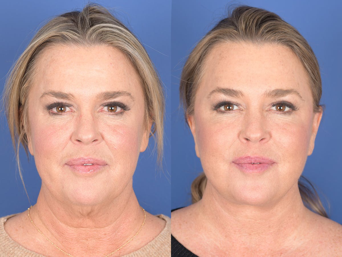 Facelift Before & After Gallery - Patient 174639 - Image 1