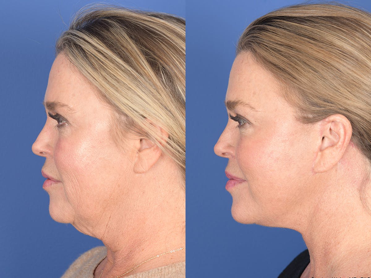 Facelift Before & After Gallery - Patient 174639 - Image 2