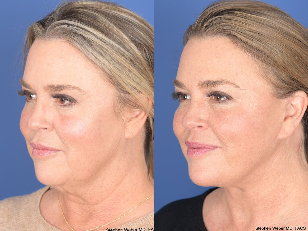 Facelift Before & After Gallery - Patient 174639 - Image 3