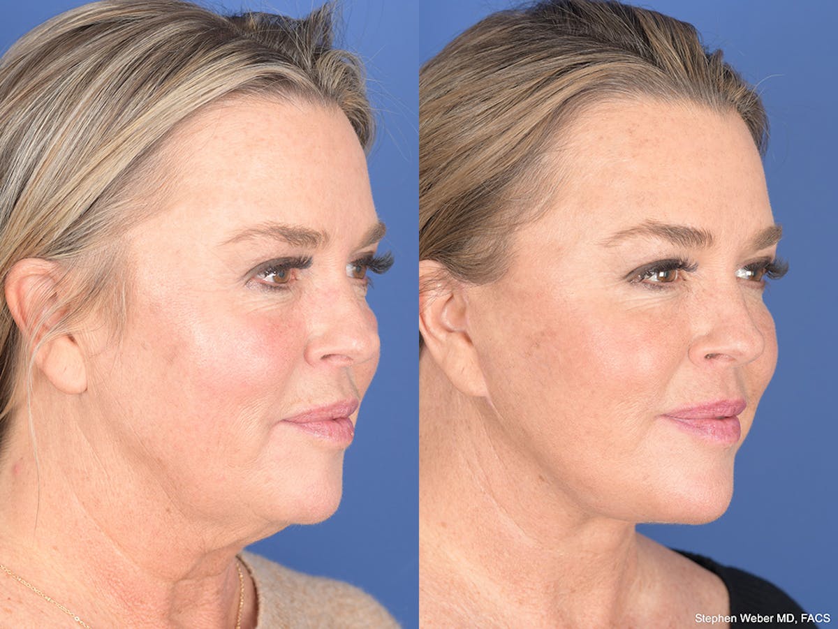 Facelift Before & After Gallery - Patient 174639 - Image 4