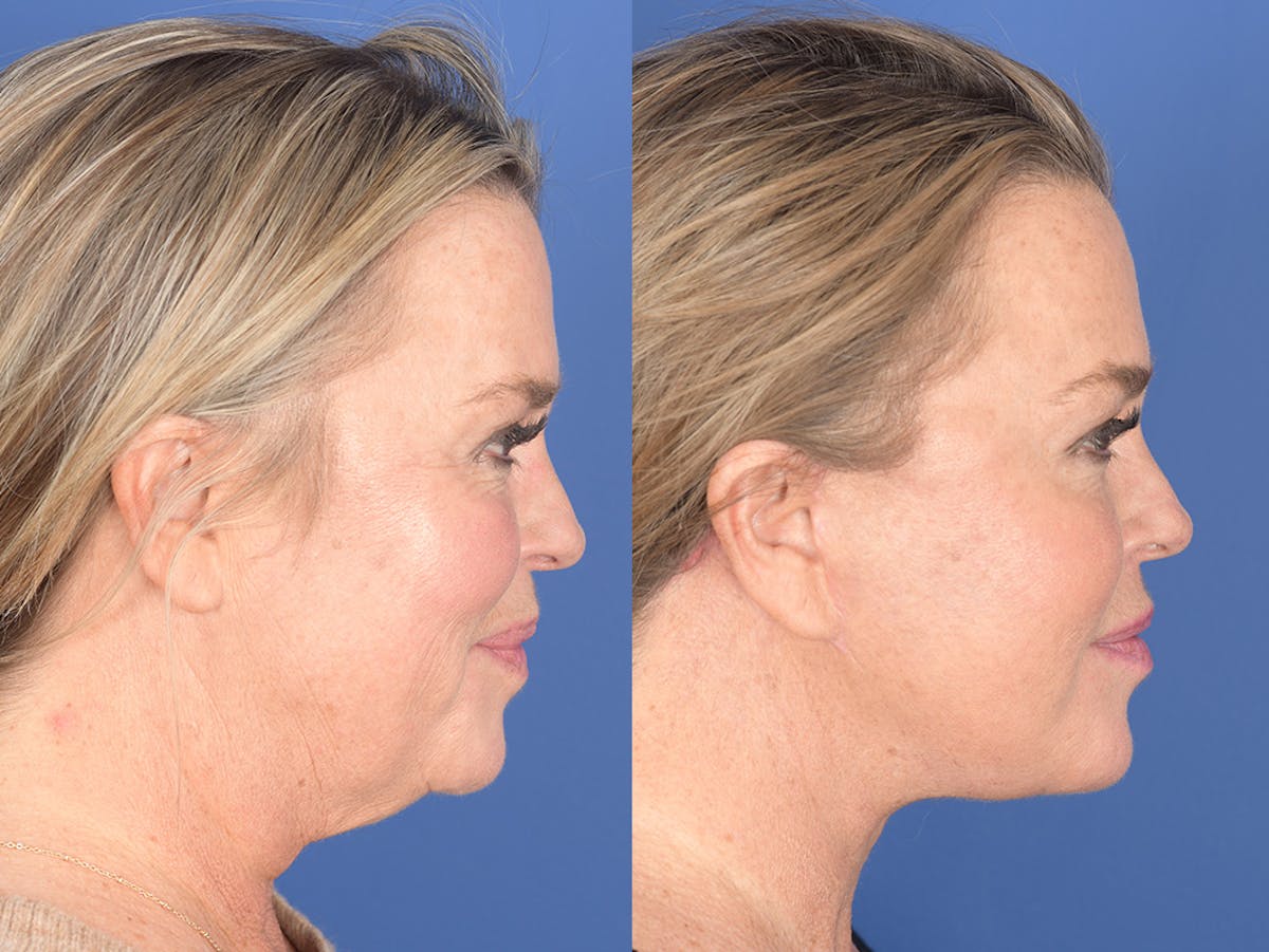 Facelift Before & After Gallery - Patient 174639 - Image 5