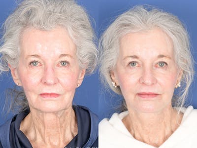 Facelift Before & After Gallery - Patient 291451 - Image 1